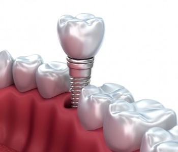 Oral Implantology
