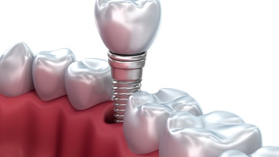 Cerrahi dental implantlar